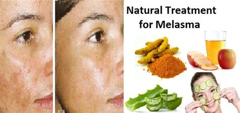 99 Best Natural Remedies To Get Rid Of Melasma Forever Images On