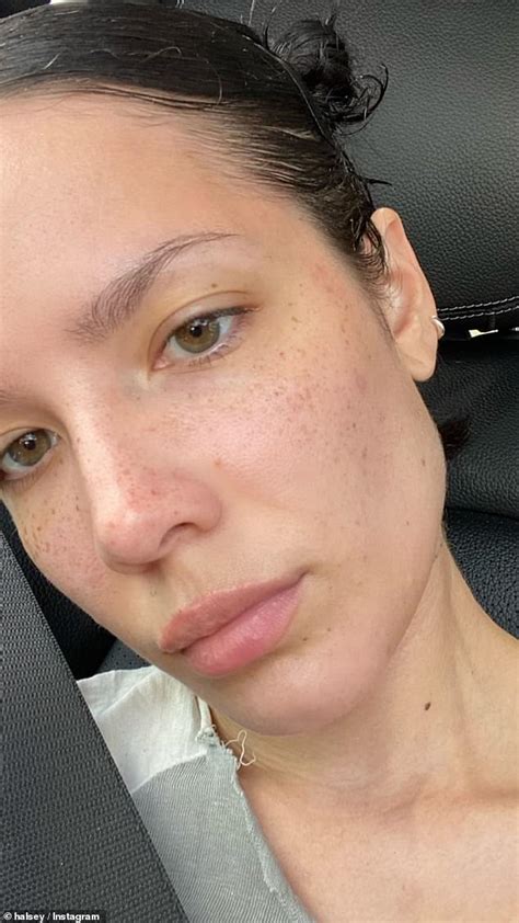 Halsey Shows Off Her Freckles In A Selfie After Showing Off Medical