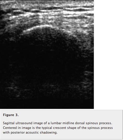 Ultrasound For Lumbar Puncture How To Maximize First Pass Success In
