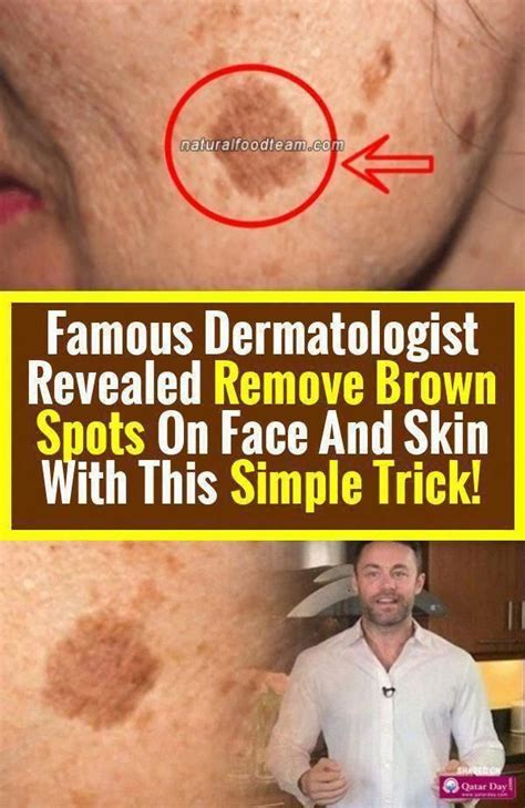 How To Get Rid Of Brown Spots On Head A Comprehensive Guide The