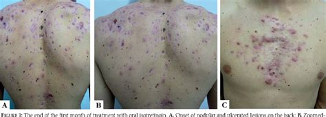 Figure 1 From Pseudo Acne Fulminans Associated With Oral Isotretinoin