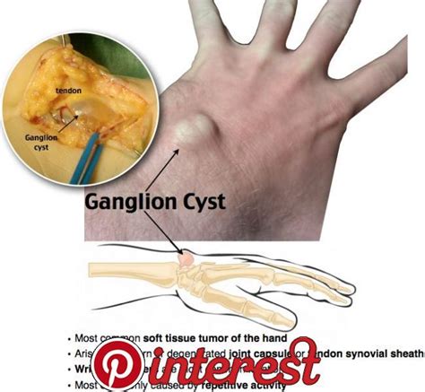 Ganglion Cyst Extensor Tendon