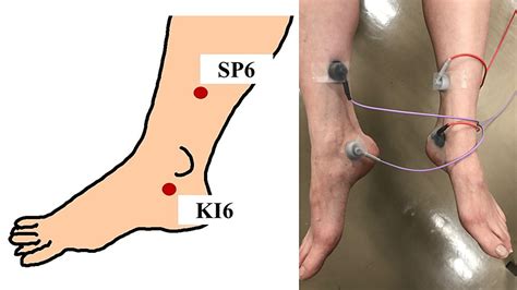 Cureus Efficacy Of Transcutaneous Tibial Nerve Stimulation With Silver Spike Point® Electrodes