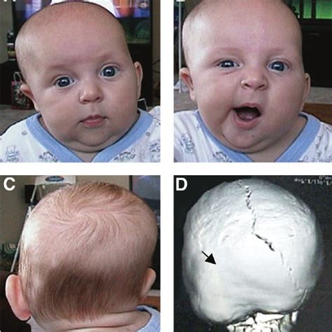 Plagiocephaly Hot Sale Off 52