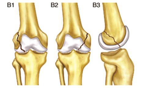 The distal femur has a trapezoidal shape in cross section 2. Distal Femur AO type 33 B - Surgical options, Results and ...