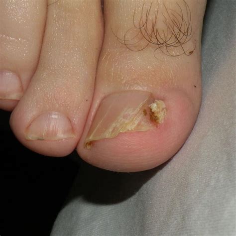 Runners Simple And Painful Ingrown Toenail Runnerclick