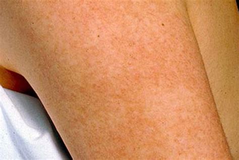 Is There A Keratosis Pilaris Cure Kp Elements