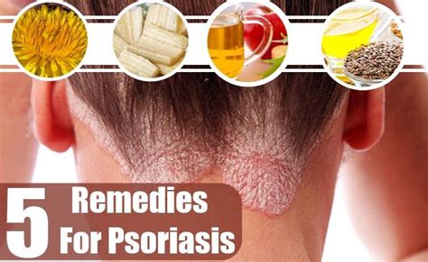 Top 5 Powerful Home Remedies For Psoriasis Natural Psoriasis Remedies