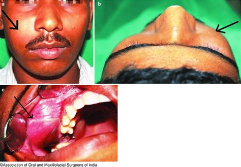 5 Clinical Examination Extraoral Inspection A Extraoral Swelling On