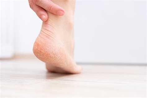 Cracked Heels Causes Remedies Prevention And More Healthwire