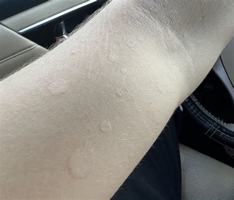 What Are These Spots On My Arms Rdermatology