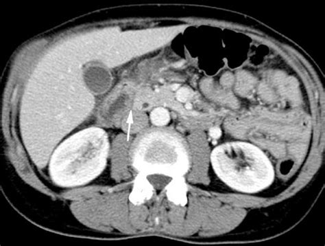 Contrast Enhanced Ct Scan Shows The Presence Of Fluid White Arrow