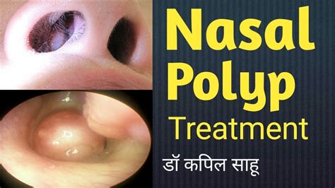 Nasal Polyps Nasal Polyps Treatment नाक के अंदर गांठ का इलाज Youtube