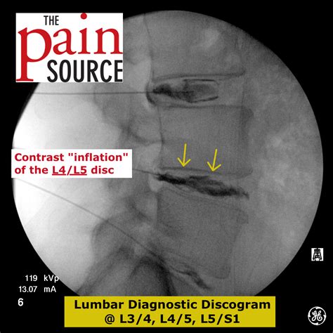 Lumbar Discogram Lateral View L4 L5 Contrast The Pain Source The