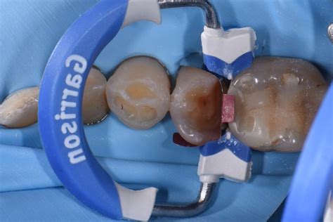 Rejuvenation Using Composite Resin Restorative Dentistry Auckland