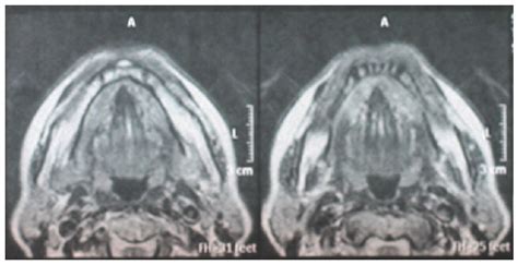 Chronic Sclerosing Sialadenitis Of The Sublingual Gland Case Report