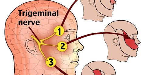 Trigeminal Nerve Axial Mri Sexiz Pix