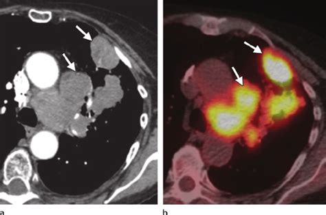 Small Cell Lung Cancer Chest Ct Scan A And Corresponding Petct