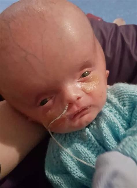 Baby Born With Swollen Head And No Anus As Rare Condition Crushed His