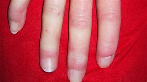 Fatigue Haq And Hand Disability Correlated In Early Systemic Sclerosis