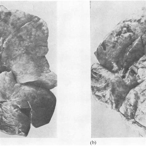 Left A And Right B Lungs Showing The Post Mortem Appearances In