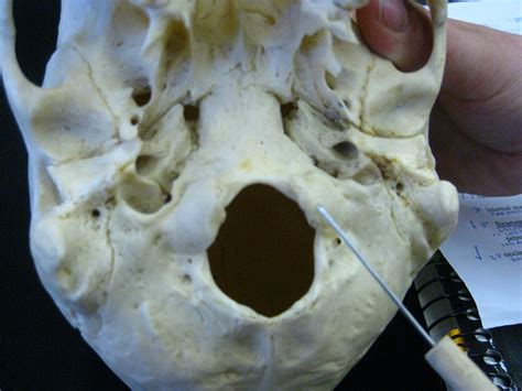 Boned: Human Skull - occipital condyle (of occipital bone)