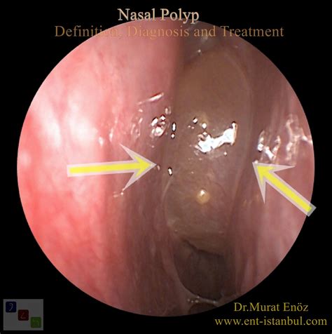 The majority of people with nasal polyps will experience nasal congestion, which may be severe and unable to be helped by sometimes, a ct scan (cat scan) of the sinuses is needed to make a diagnosis. Nasal Polyp - Definition, Symptoms, Diagnosis and Treatment