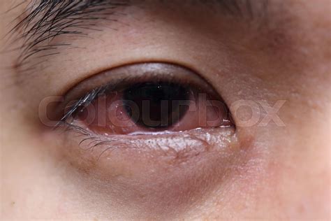 Red Sore Allergy Eye Stock Image Colourbox
