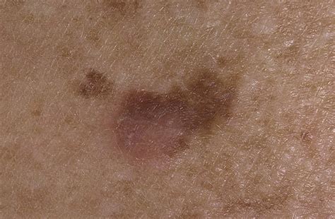Signs Of Melanoma Pictures 27 Photos And Images