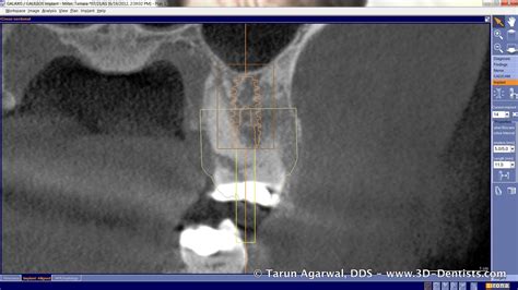 Extraction Internal Sinus Lift Immediate Implant And Final