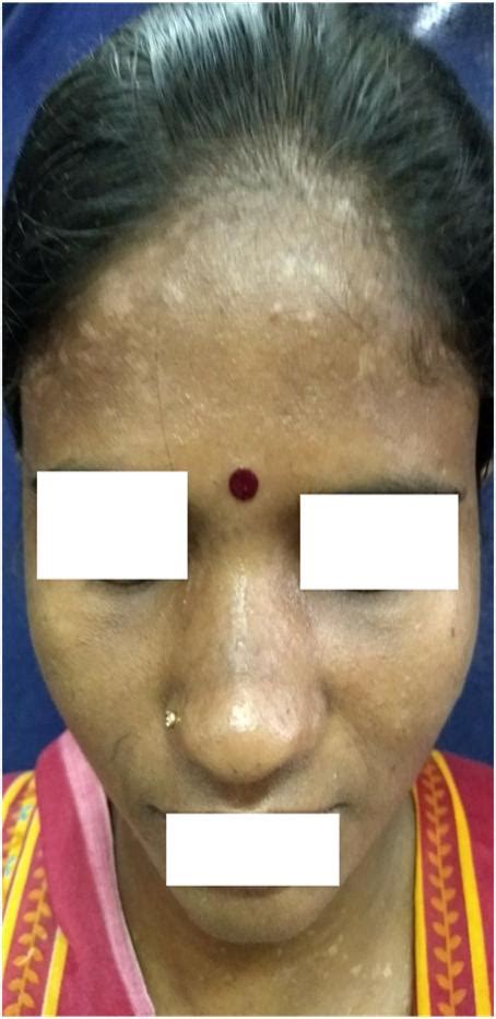 Epidermodysplasia Verruciformis A Rare Disoder With A Rarer Incidence In Indian Population