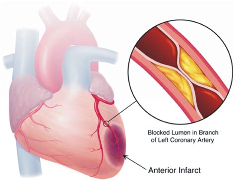 Myocardial Ischemia Due To Coronary Artery Blockage Celebrate Life