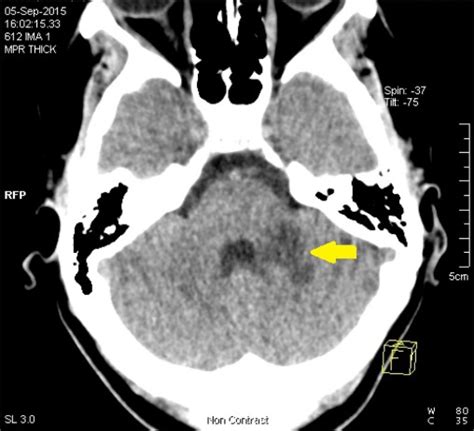 Axial Non Contrast Ct Scan At The Level Of Cerebellum Showing Ischemic
