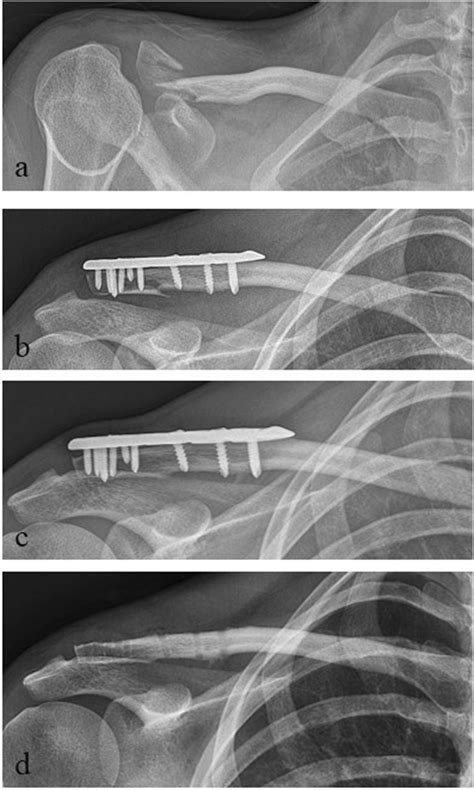 Radiological Outcome Of A Lateral Clavicle Fracture Jandb Ii B A