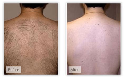 Laser Hair Removal Primary Walk In Medical Center