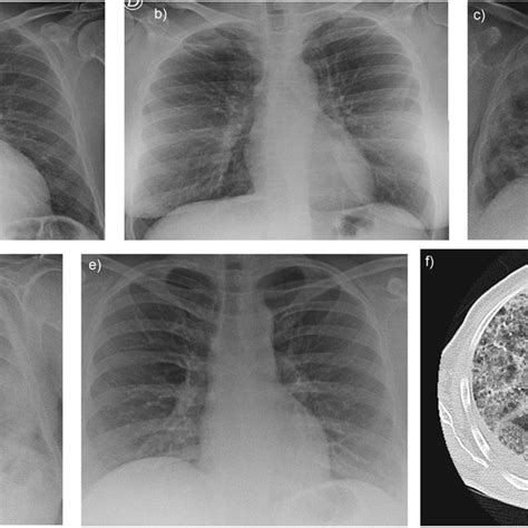 Chest X Ray In Our Series Show Bilateral Infiltrates With An