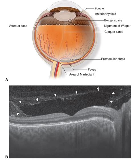 Cross Section Of Vitreous Anatomy American Academy Of Ophthalmology