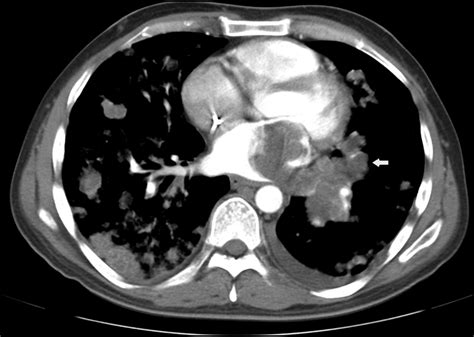 Axial Ct Of The Chest Showing A Large Thrombus Within The Pulmonary