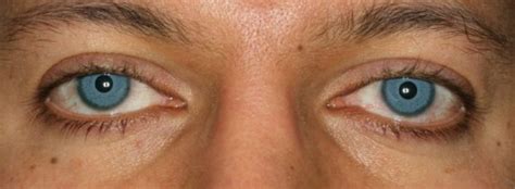 Empfehlung Vielfalt Schlecht Laser Eye Color Surgery Before And After