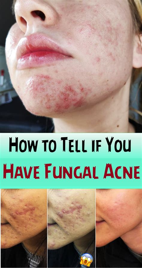 How To Tell If You Have Fungal Acne And The Best Way To Actually Get
