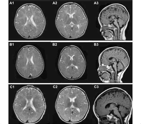 Brain Mri Of Patients With Pmd A1 A3 B1 B3 And C1 C3 Represent The