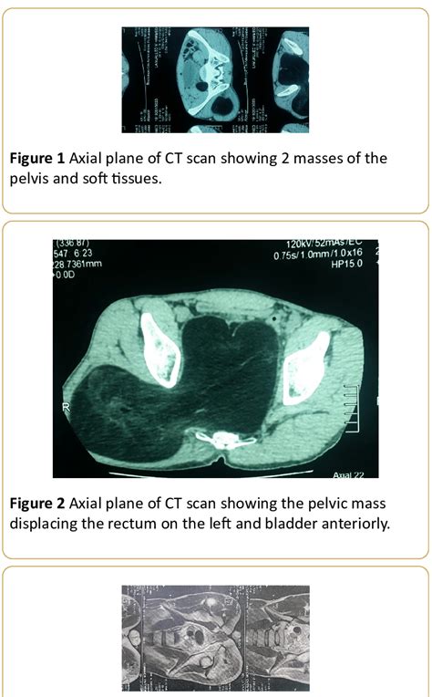 Magnetic resonance imaging (mri) is arguably the most sophisticated imaging method used in clinical medicine. MRI showing appearance of tumor residue-T1 weighted ...