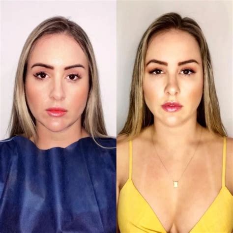 Veja o antes e depois de famosos que fizeram harmonização facial Portal O Norte