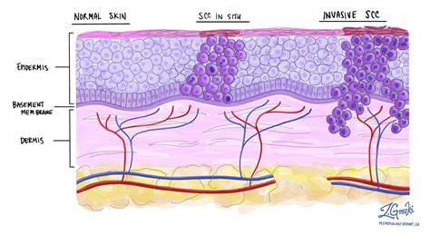 Squamous Cell Carcinoma Of The Skin Mypathologyreportca