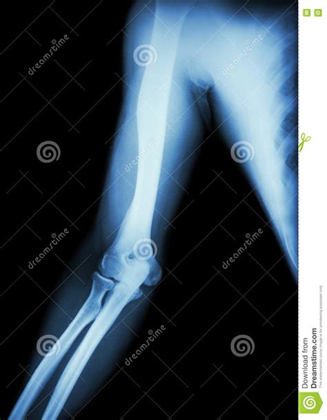 Film X Ray Of Normal Arm Elbow And Forearm Stock Photo Image Of
