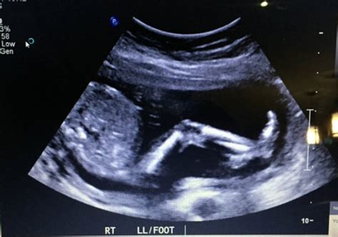 19 Week Ultrasound And Tech Didnt Find Gender Update September 2015