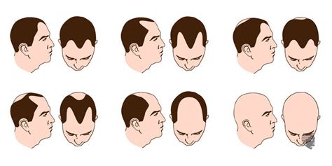 Hair Loss At An Early Age The First Sign Your Youth Is Fading Ahs India