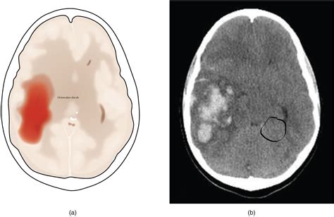 Ein gutes ergebnis erzielt man. Ciri-Ciri Penyakit Stroke | Stroke Informations