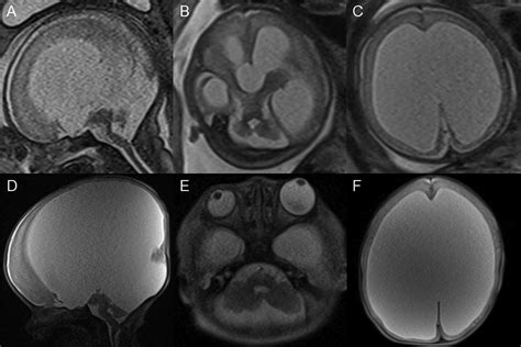 Differential Diagnosis Of Ventriculomegaly And Brainstem Kinking On