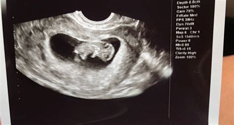 9 Week Ultrasound No Movement From Baby 1st Time Mommies Forums